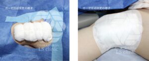 ダウンタイム　ガーゼ圧迫固定　腋臭症手術（皮弁法・剪除法）（保険適応 ) 大阪梅田LSクリニックのわきが治療