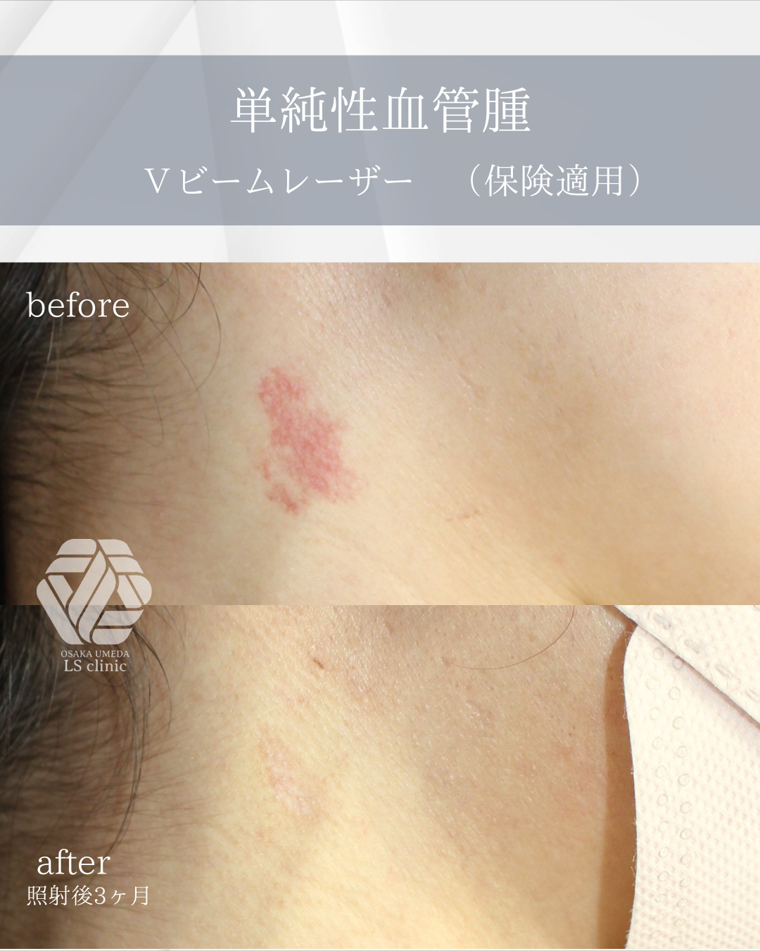 単純性血管腫 Vビームレーザー