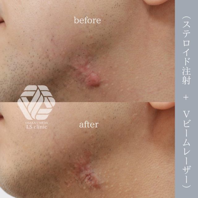 ケロイド、Vビーム、ボトックス